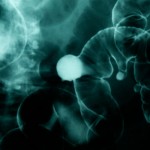 Colon Polyp
